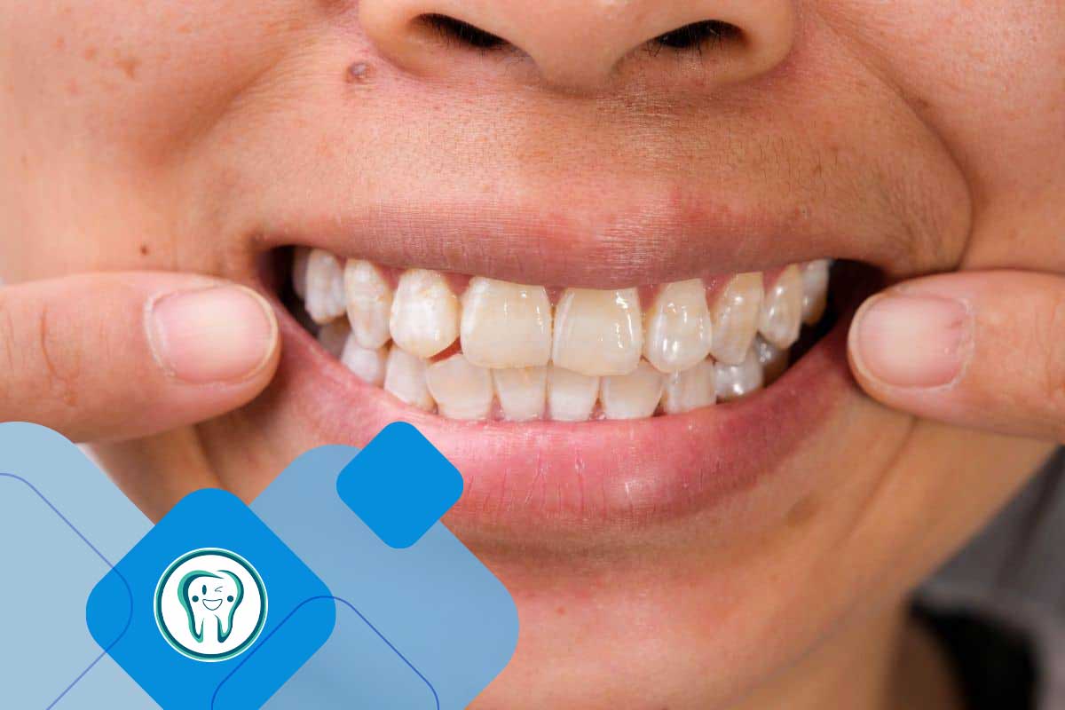 حساسیت دندان بعد از بلیچینگ دندان