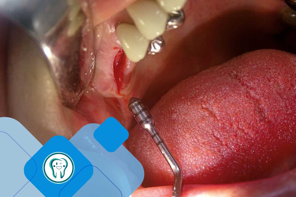 کاربردهای پیزوسرجری در دندانپزشکی