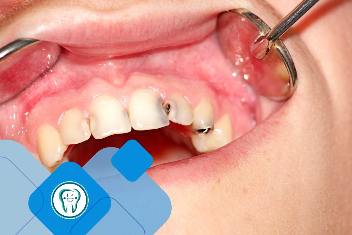  احساس پوسیدگی دندان