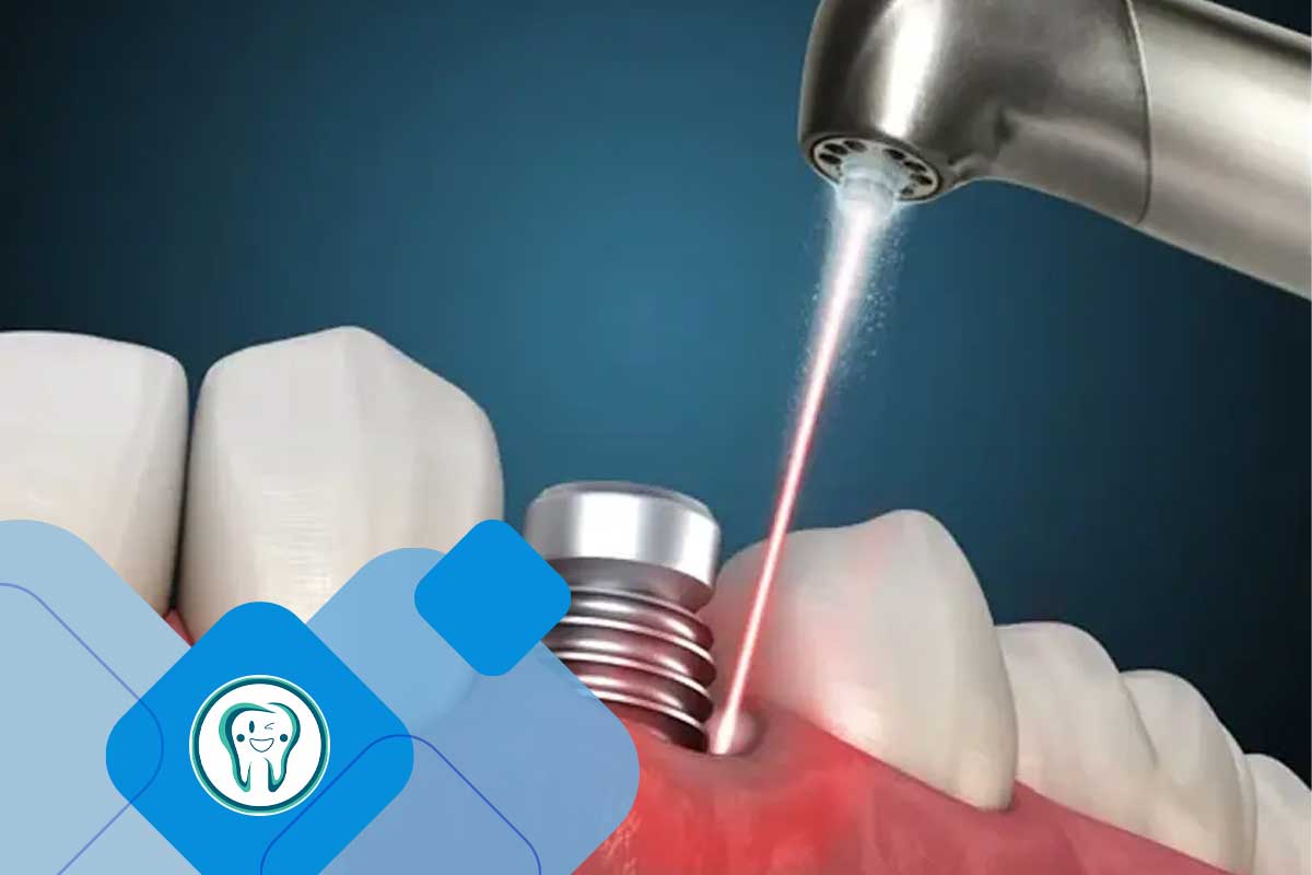 قش لیزر در آماده‌سازی محل ایمپلنت 