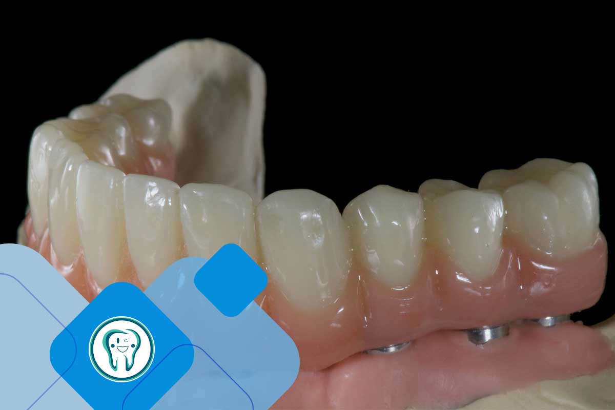 قیمت اوردنچر فک پایین