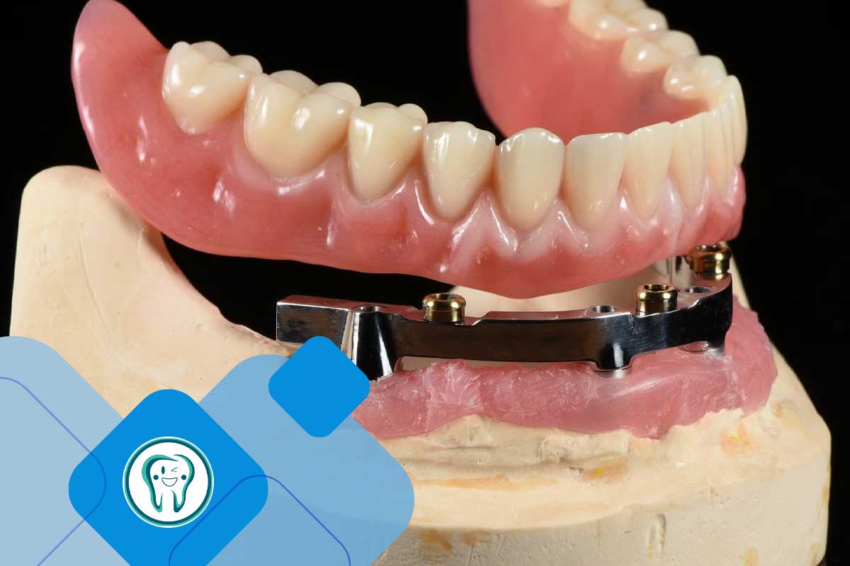 اوردنچر فک پایین