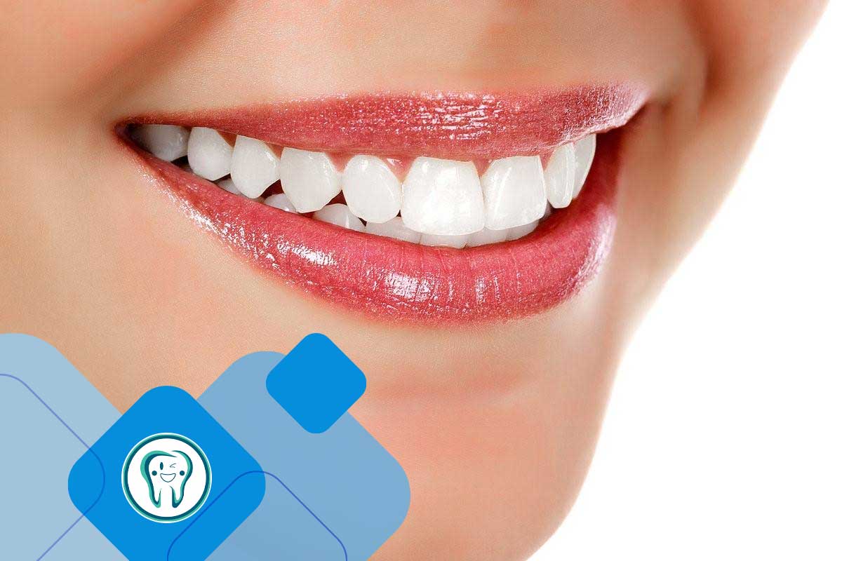 روش‌های سفید کردن دندان با هیدروژن پراکسید