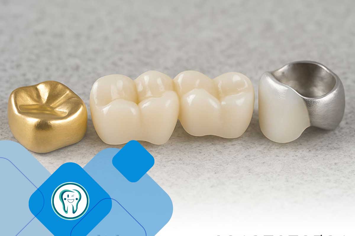 انواع روکش‌های موقت دندان 