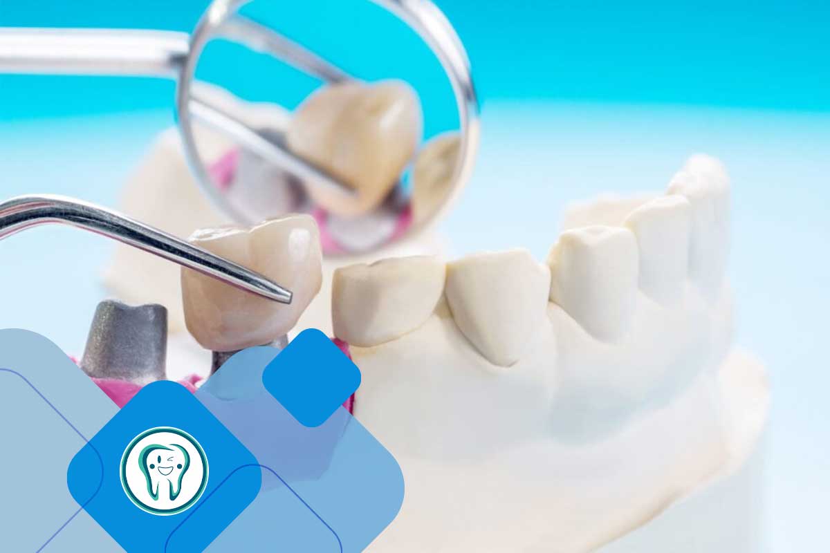 دندان موقت قبل از ایمپلنت