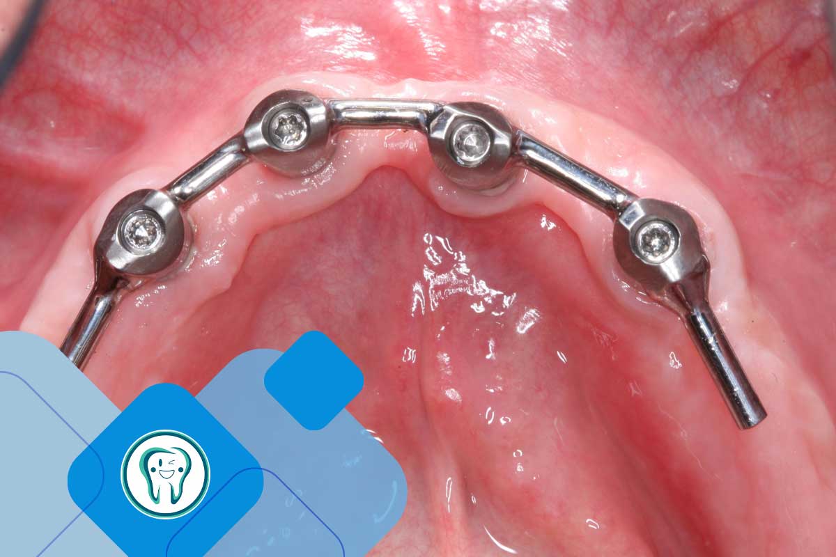 انواع اوردنچر فک پایین