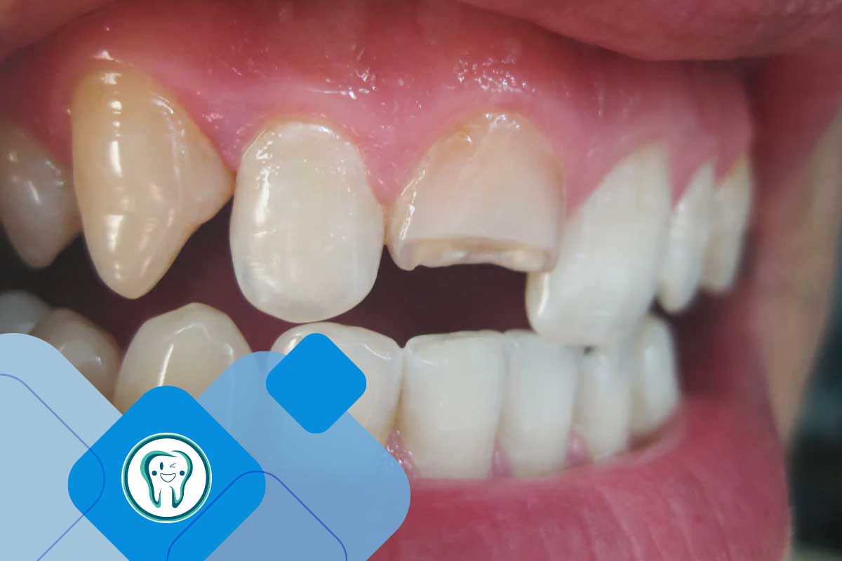 ترک یا شکستگی دندان