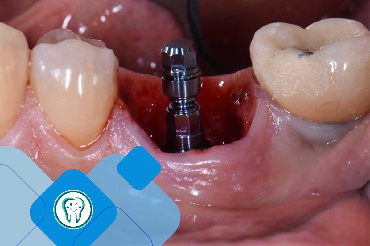 جایگذاری ایمپلنت دندانی