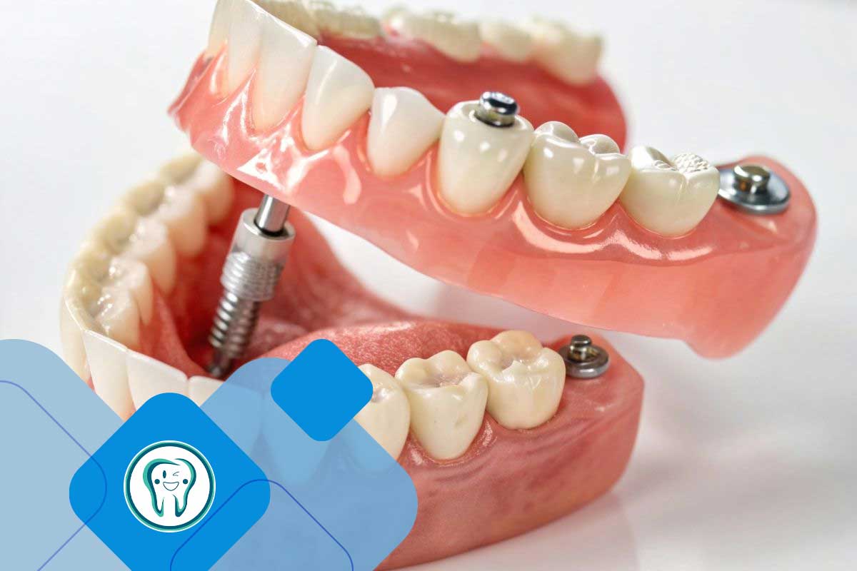 مراحل درمان ایمپلنت دندان 