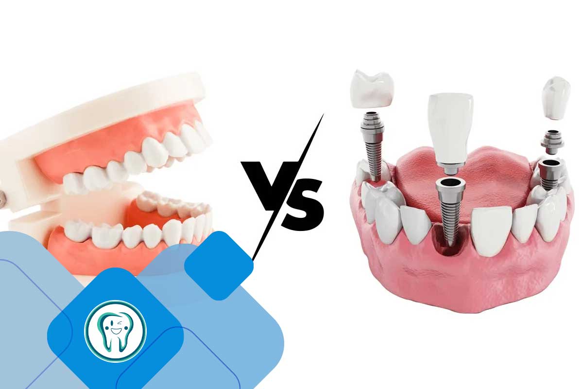 ایمپلنت دندان یا دندان مصنوعی