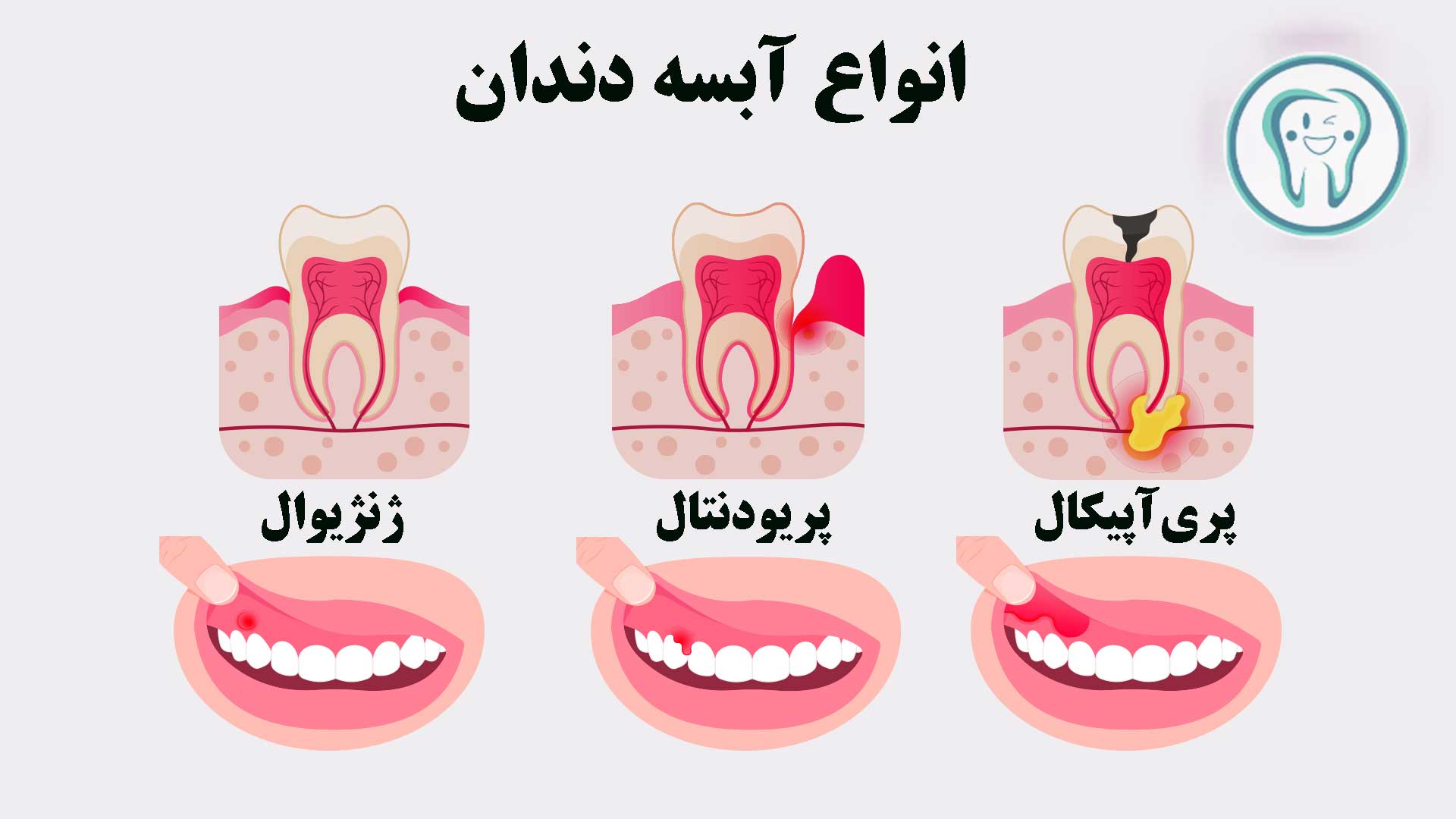 انواع آبسه دندان