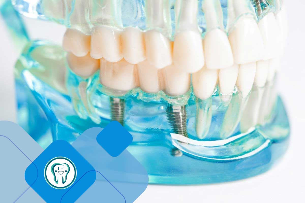 استفاده از آب نمک پس از ایمپلنت