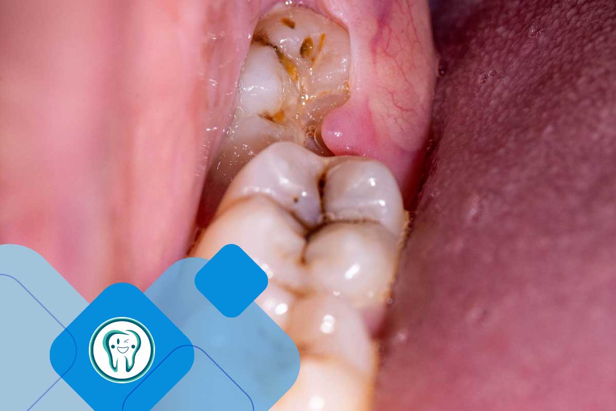 wisdom tooth abscess
