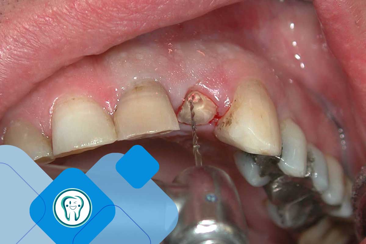 خطرات به تعویق انداختن بیش از حد ایمپلنت