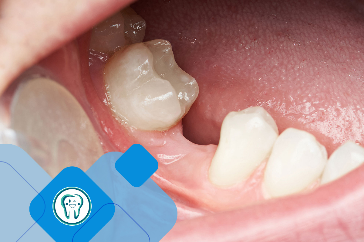 انواع زمان‌بندی ایمپلنت پس از کشیدن دندان