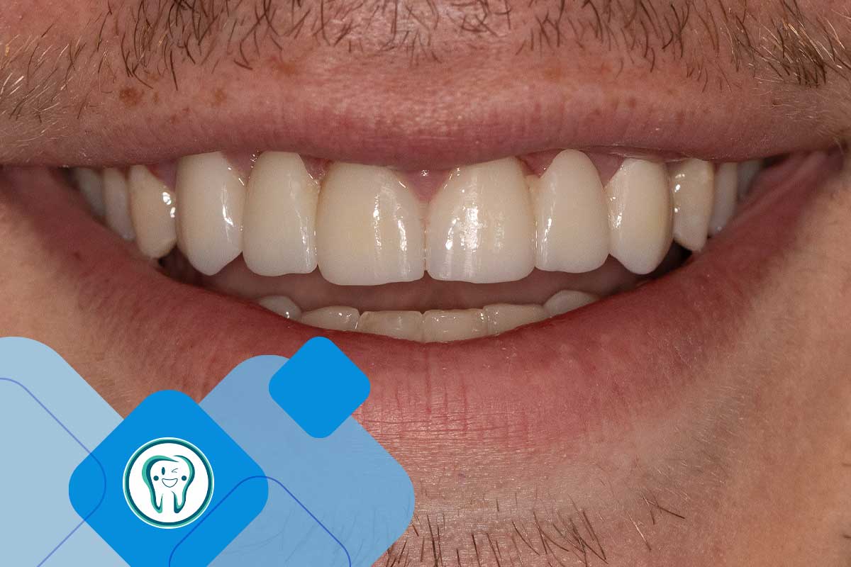 فرق بین پروتز دندان و ایمپلنت