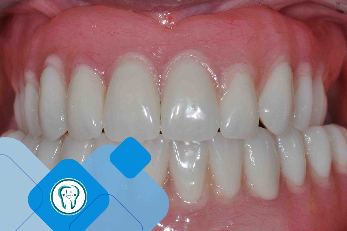 پروتز دندان چیست؟ راهکاری برای ترمیم و بازسازی