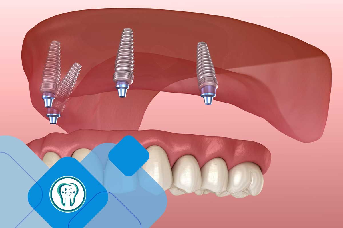 ایمپلنت دندان چیست؟ جایگزینی از ریشه تا تاج
