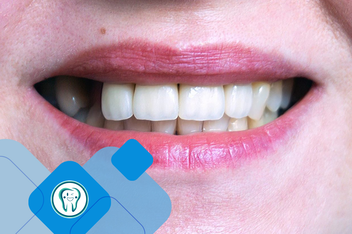 ایمپلنت بعد از کشیدن دندان