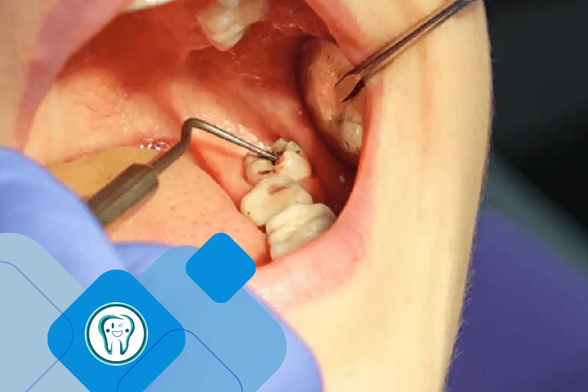 کشیدن دندان به روش معمولی (Simple Extraction) چیست؟