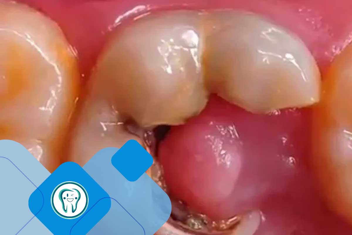 آیا این گوشت اضافه داخل دندان، خطرناک یا سرطانی است؟