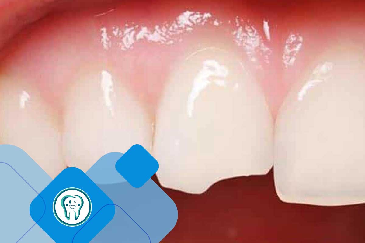 خطای دید در دندانپزشکی: چرا هر شکستگی دندان مساوی با کشیدن نیست؟