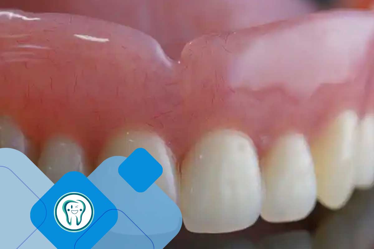 چگونه از بروز مجدد زخم لثه دندان مصنوعی جلوگیری کنیم؟ (پیشگیری بهتر از درمان)