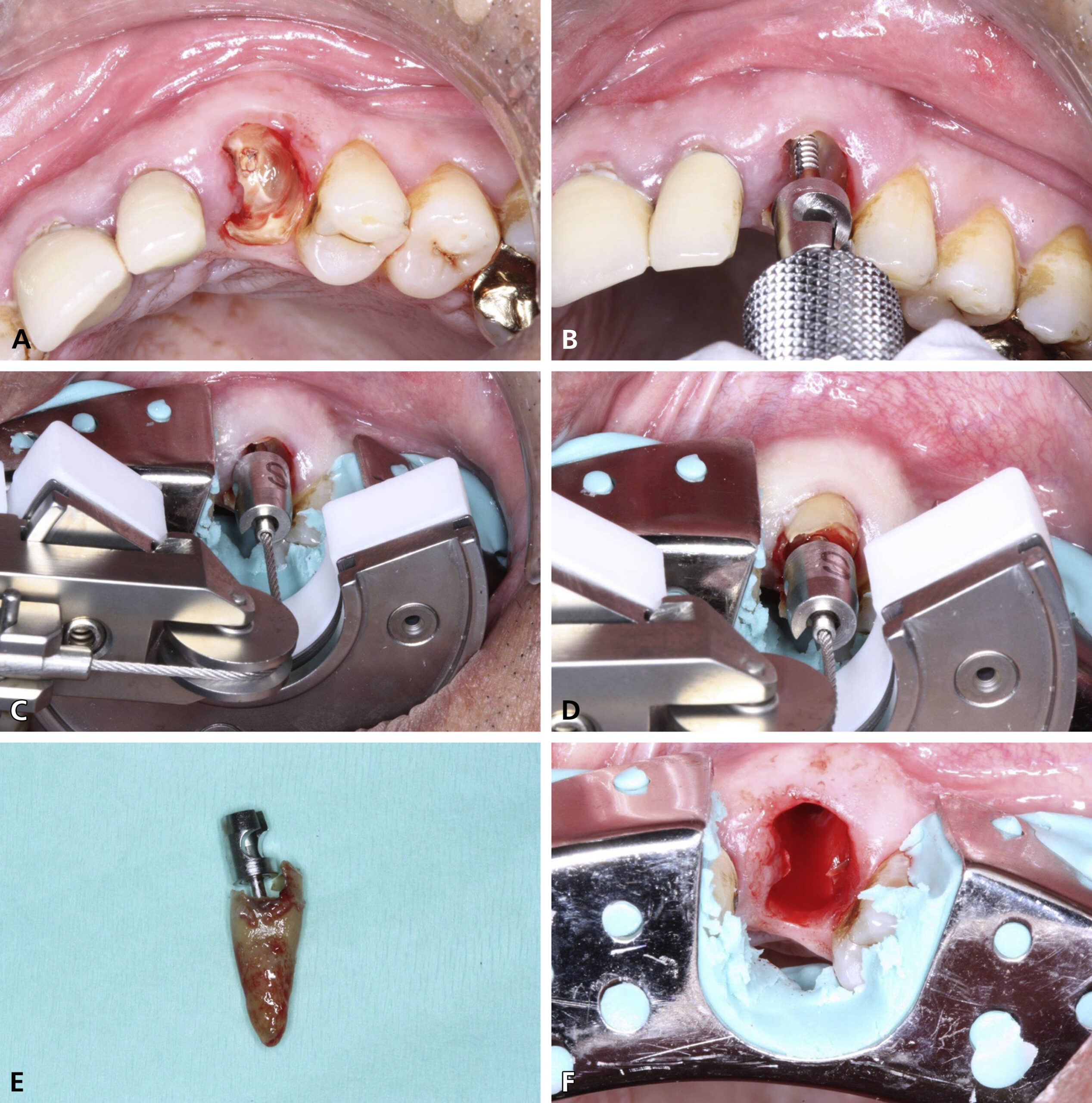 جراحی دندان (Surgical Extraction) چیست و چرا تجویز می‌شود؟