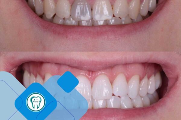 کلینیک تخصصی دندانپزشکی دکتر محسن بیاتی 20 عکس بلیچینگ دندان اقساطی
