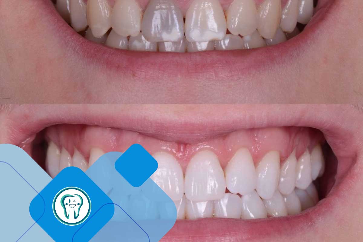 عکس بلیچینگ دندان اقساطی