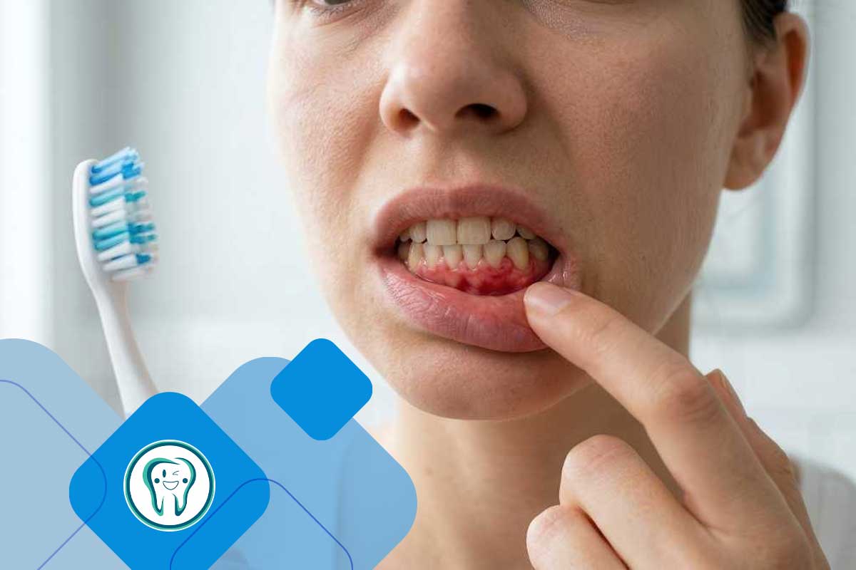 علتهای شایع درد لثه چیست؟ 1 علائم درد لثه