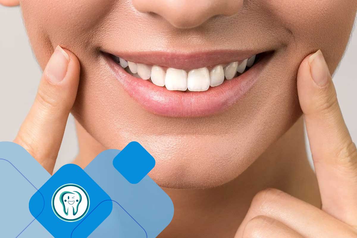 تفاوت بلیچینگ و لمینت دندان 2 لمینت دندان