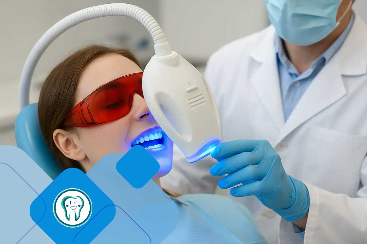 تفاوت بلیچینگ و لمینت دندان 1 بلیچینگ دندان