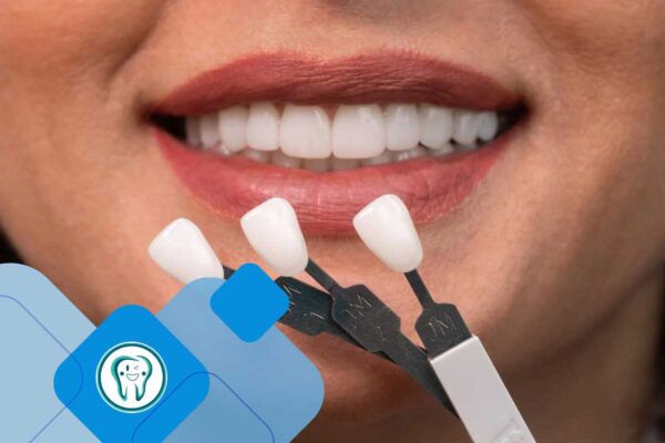 کلینیک تخصصی دندانپزشکی دکتر محسن بیاتی 19 تفاوت بلیچینگ و لمینت دندان