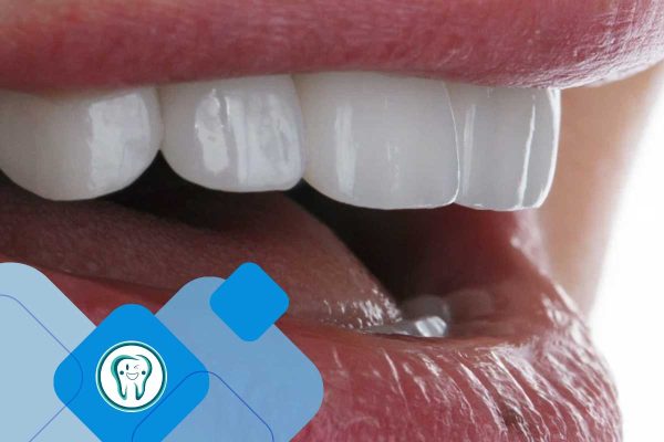 کلینیک تخصصی دندانپزشکی دکتر محسن بیاتی 28 طراحی لبخند با کامپوزیت