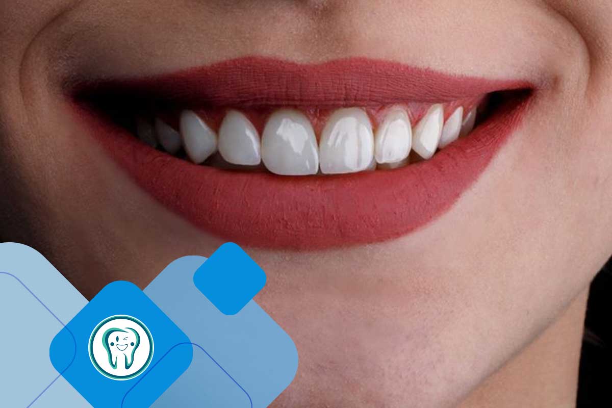 طراحی لبخند با کامپوزیت در دندانپزشکی زیبایی 1 مزایای طراحی لبخند با کامپوزیت