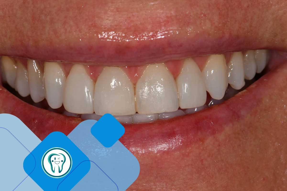 طراحی لبخند با کامپوزیت در دندانپزشکی زیبایی 2 CPT 3669