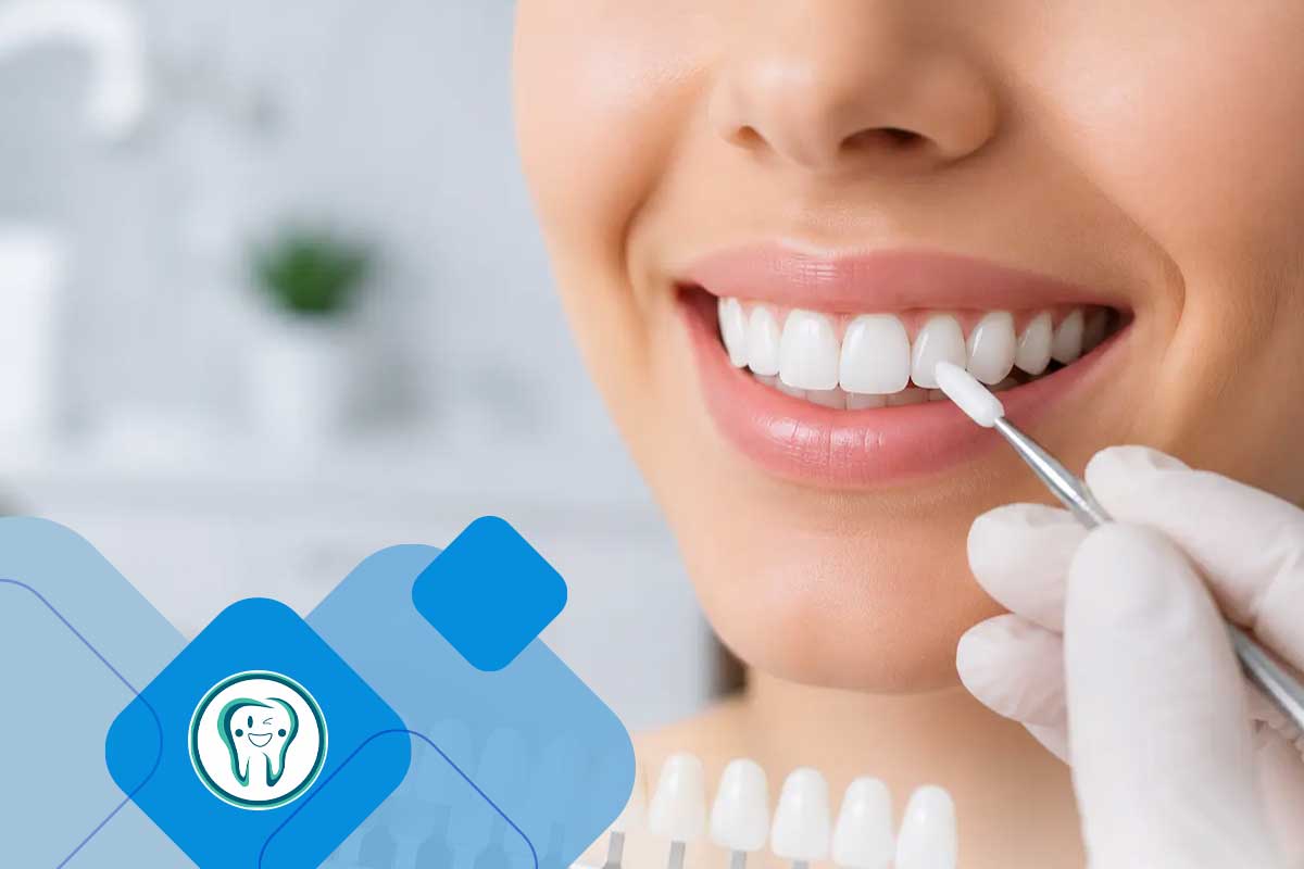 طراحی لبخند با کامپوزیت در دندانپزشکی زیبایی 3 Composite Bonding Complete Guide to Smile Design