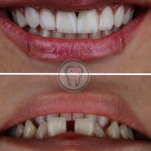 Composite-veneer-treatment-2