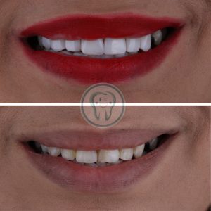 Example-of-composite-veneer-treatment