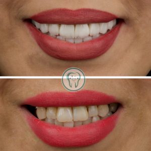 Example-of-dental-composite-treatment-in-Karaj