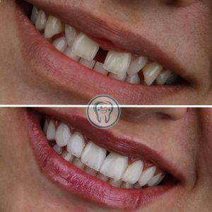 Example-of-dental-laminate-treatment-in-Karaj